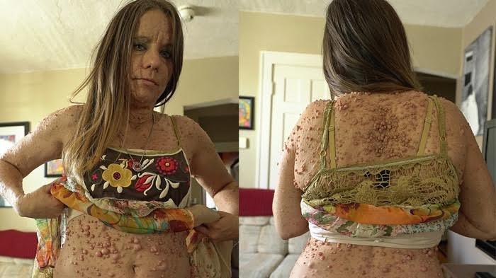 Cum arată femeia care are peste 6000 de tumori pe corp! Toată lumea îi privește atent pielea și se miră