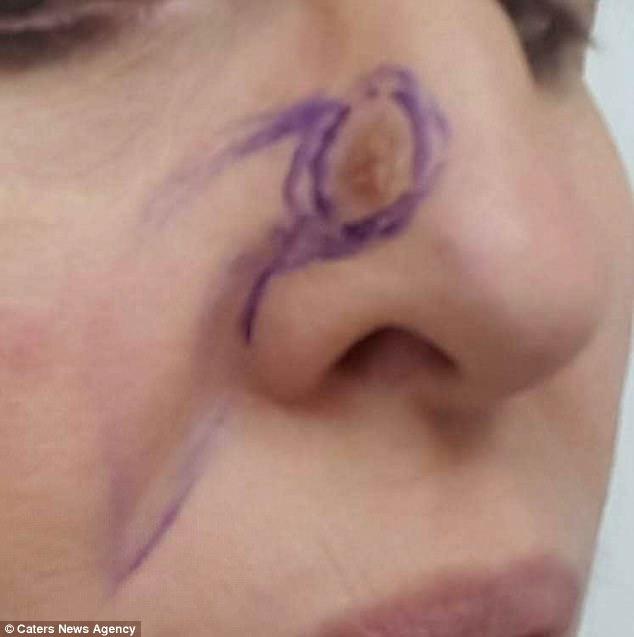 A aflat că are cancer în cel mai bizar mod posibil. Urmele lăsate de ochelari sunt de vină