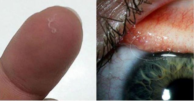 O tânără a crezut că are o geană în ochi. Când a verificat, avea 14 viermi