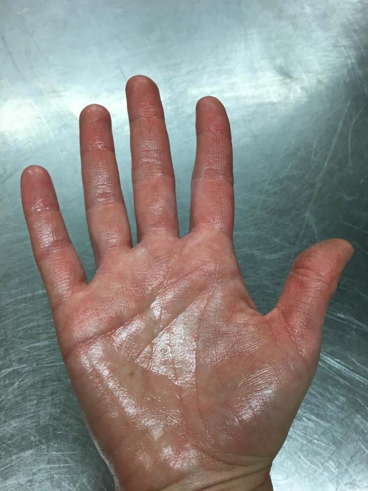 Cazul care face înconjurul lumii. Femeia suferă de o boală extrem de rară. Ce se întâmplă în fiecare zi cu mâinile şi picioarele ei" „Nu îmi pot face un iubit”