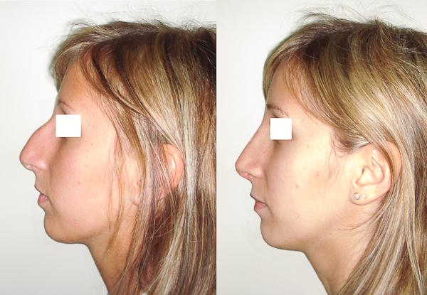 Și tu confunzi Rinoplastia cu Deviația de Sept? Faci cea mai mare greșeală! Ce trebuie să stii, dacă vrei sa iți operezi nasul