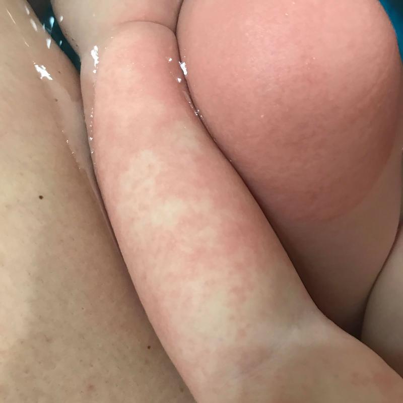 O fetiţă se confruntă cu una dintre cele mai grele alergii din lume: nu se poate atinge de apă! Și dacă plânge, pielea-i devine o rană deschisă