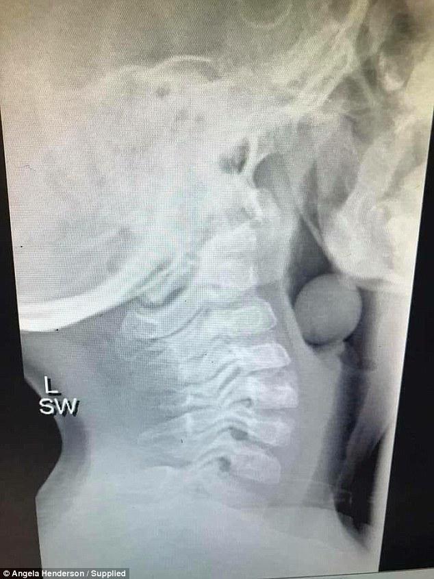 Radiografia de pe Facebook care i-a îngrozit pe părinți! Un bob de strugure în gâtul unui copil de cinci ani