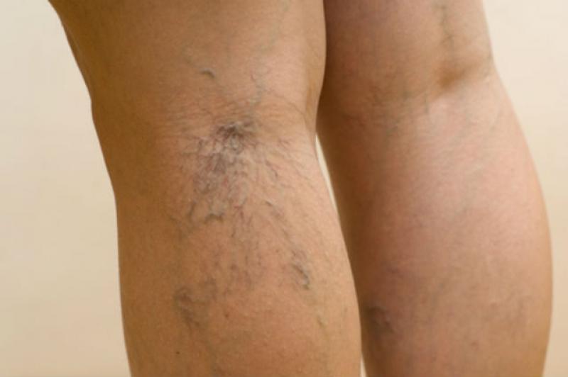 Masajul picioarelor este sigur pentru varice, care pot fi contraindicațiile? - Complicații August