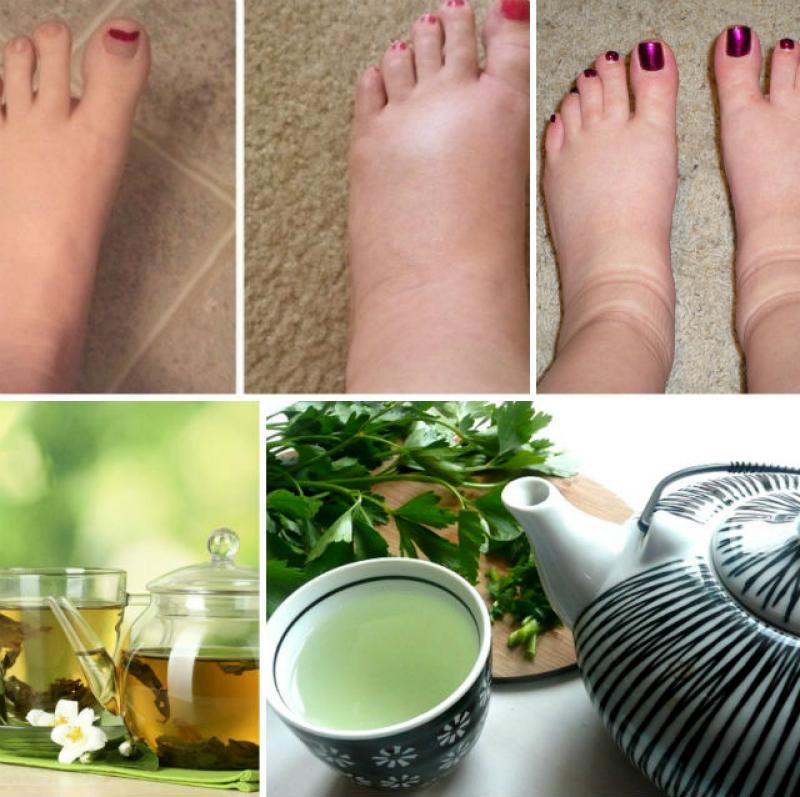 Picioarele umflate - acest ceai naturist te poate ajuta