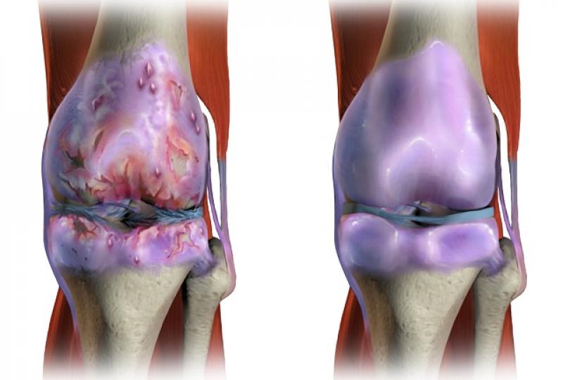 genunchii răniți  articulațiile se crispau boală de mobilitate articulară