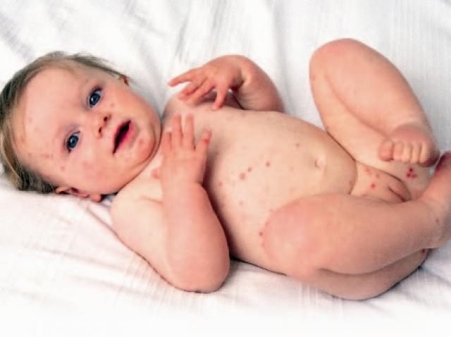 Rujeola Boala Contagioasa A Copilariei