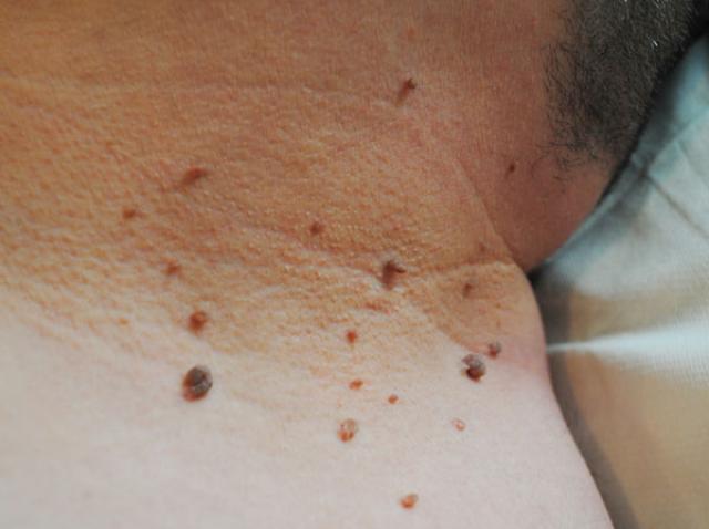 invinge negii si alunitele in 14 zile hpv skin warts treatment