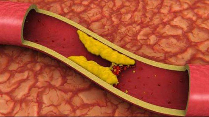 Top 10 alimente care scad colesterolul. Sănătatea vine mâncând!