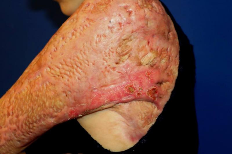 Ce se întâmplă în spitalele de ARȘI din alte țări. Declarația unui supravuiețuitor din Colectiv SALVAT într-un spital din Israel pune la pământ România