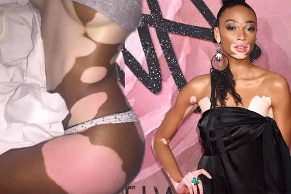 Lucrează ca fotomodel deși suferă de o boală de piele incurabilă de care toată lumea fuge. Acum se bucură de un succes uriaș și le dezvăluie oamenilor care este secretul succesului