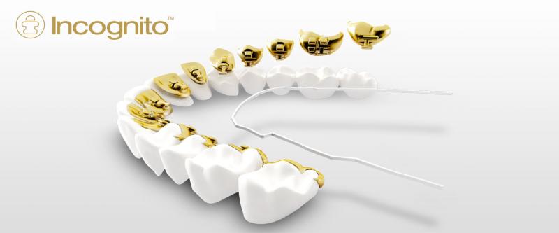 Ce beneficii poate avea purtarea unui aparat dentar asupra stilului tau de viata si a sanatatii orale?