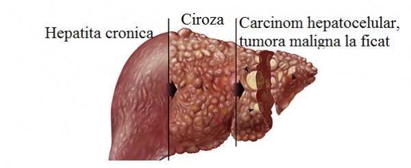 VIRUSUL care face RAVAGII în România. Jumătate de MILION de oameni, AFECTAȚI. Nu, nu este virusul GRIPAL