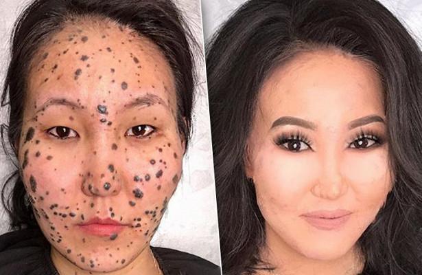 O tânără care suferea de o boală de piele rară, preclită „FEMEIA-DALMAȚIAN”, a fost transformată total cu ajutorul machiajului