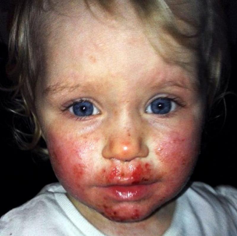 O mamă nu a ripostat când o rudă i-a pupat fetița pe obrăjori. Micuța a fost apoi la un pas de moarte, după ce virusul Herpes „a mâncat-o de vie”