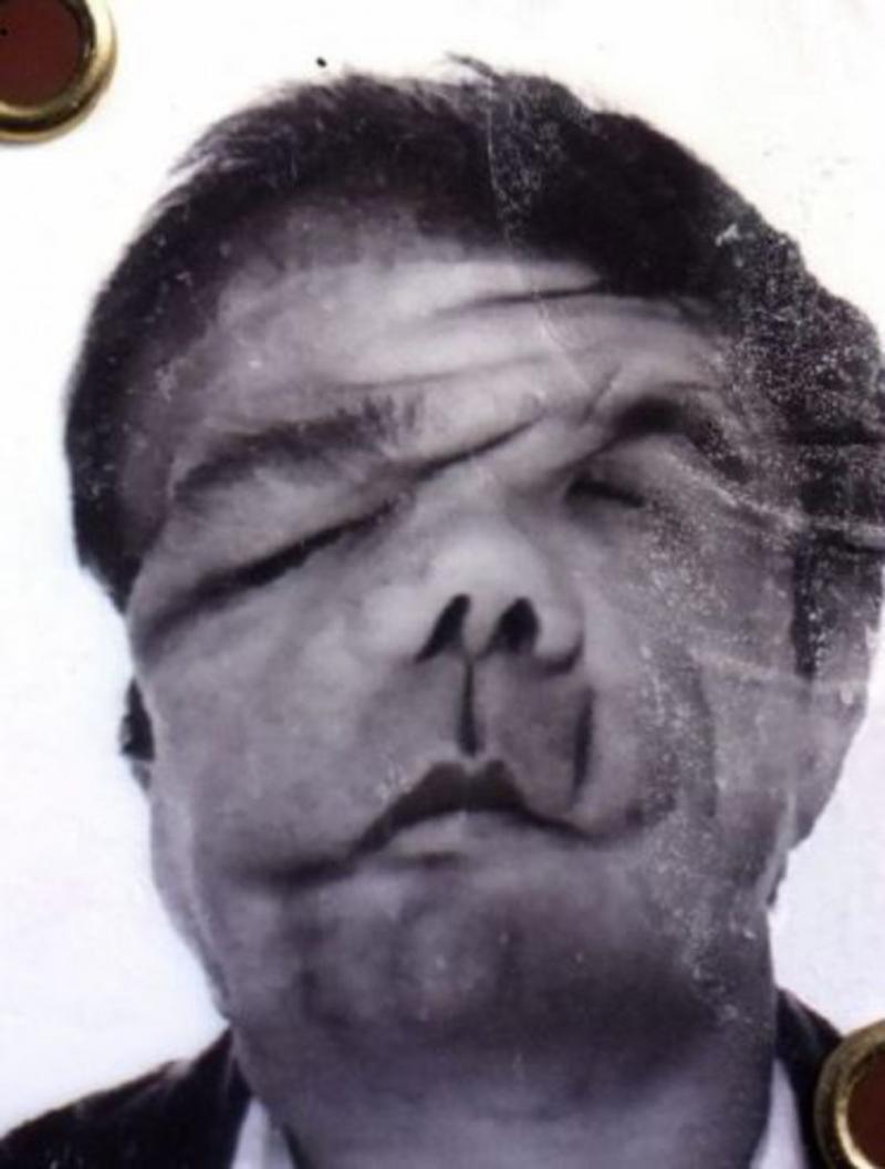 Imagini șocante! Omul cu trei chipuri s-a arătat lumii: A stat două luni fără față și a primit grefe de la viermi marini