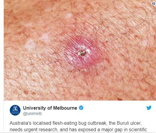 Medicii sunt în alertă! O bacterie ”mâncătoare de carne” face ravagii printre australieni