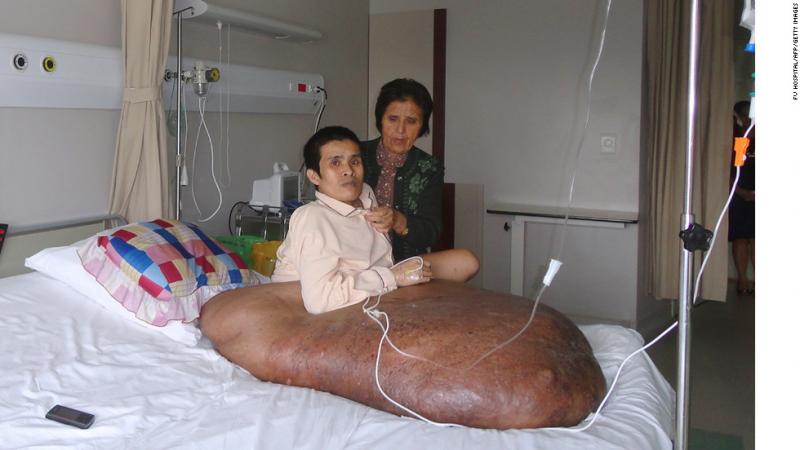 Vă aduceți aminte de cazul Lucicăi Bunghez? O tumoare masivă, de 45 de kilograme, a fost operată de medici, în Vietnam