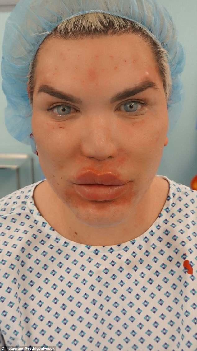 Păpușa Ken, tratament anti-aging șocant! Și-a injectat placentă în față. Rezultatul?