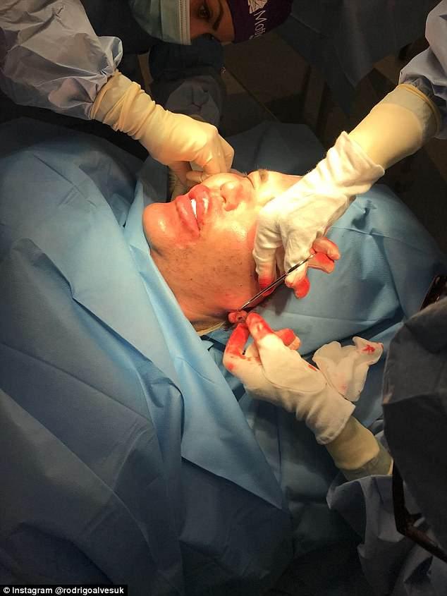 Păpușa Ken, tratament anti-aging șocant! Și-a injectat placentă în față. Rezultatul?