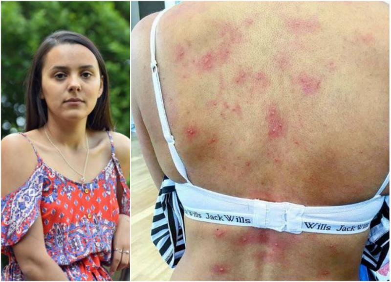 O femeie este ALERGICĂ la apă. Este înfiorător ce păţeşte după fiecare duş sau dacă o prinde ploaia. Nici medici nu ştiu cum să o ajute