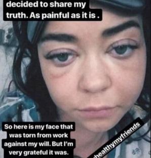 FOTO.Boala a DESFIGURAT-O! Cum a ajuns să arate una dintre cele mai frumoase actriţe