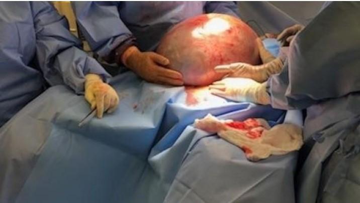 POVESTEA ȘOCANTĂ a femeii care NU PUTEA SĂ SLĂBEASCĂ. Când au văzut-o medicii, au OPERAT-O DE URGENȚĂ