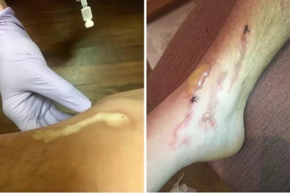 Atenție, imagini SOCANTE! Vă plimbați desculți pe plajă? Avertismentul dur al unei mame :„Uitați ce a pățit fiul meu, rugați-vă pentru vindecarea lui”