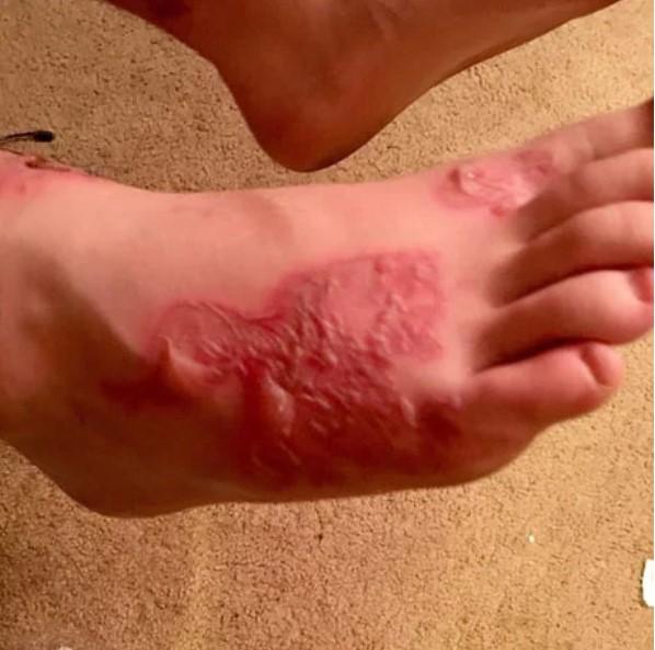 Atenție, imagini SOCANTE! Vă plimbați desculți pe plajă? Avertismentul dur al unei mame :„Uitați ce a pățit fiul meu, rugați-vă pentru vindecarea lui”