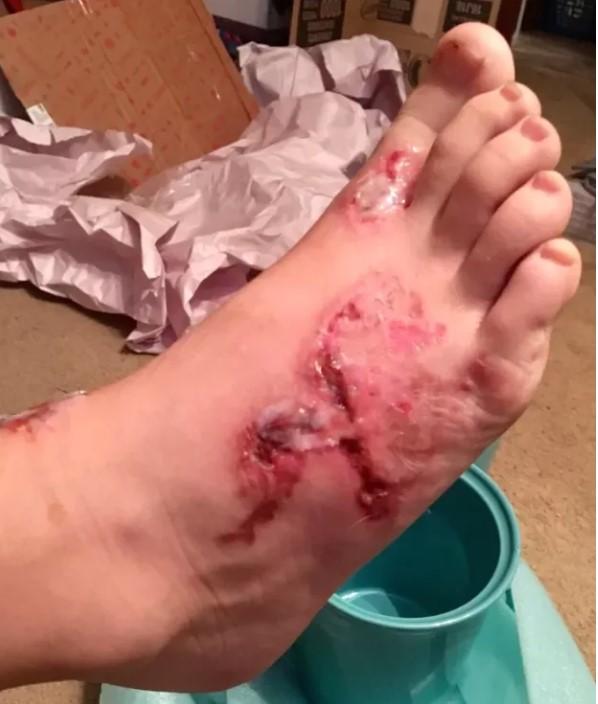 Atenție, imagini SOCANTE! Vă plimbați desculți pe plajă? Avertismentul dur al unei mame :„Uitați ce a pățit fiul meu, rugați-vă pentru vindecarea lui”