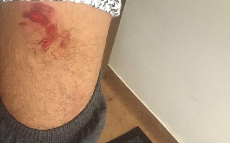 Imagini cu puternic impact emoţional! Un bărbat a fost atacat de urs, pe drumul spre casă