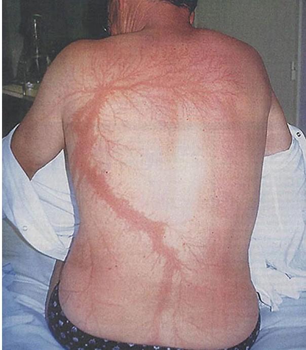 Ce apare pe pielea oamenilor trăsniți de FULGER! Galerie foto ELECTRIZANTĂ