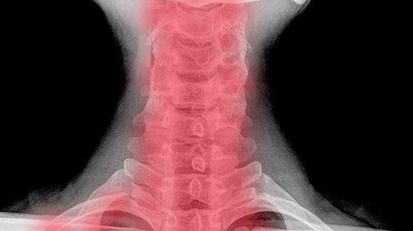 Spondiloza cervicală. Ce este? De ce apare? Cum o tratăm?