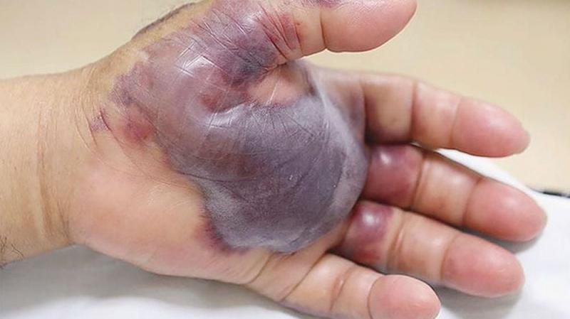 Un bărbat a m&acirc;ncat sushi, dar apoi a ajuns de URGENȚĂ la spital! Medicii s-au &icirc;ngrozit c&acirc;nd i-au văzut palmele