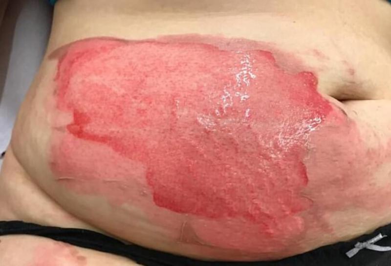 A vrut să se relaxeze și a sfărșit cu arsuri pe corp! O femeie a trecut prin chinuri cumplite de la o sticlă cu apă: „A sunat la o ambulanță și am intrat în șoc în timp ce venele mele se spărgeau”