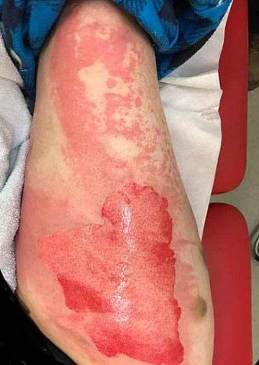 A vrut să se relaxeze și a sfărșit cu arsuri pe corp! O femeie a trecut prin chinuri cumplite de la o sticlă cu apă: „A sunat la o ambulanță și am intrat în șoc în timp ce venele mele se spărgeau”