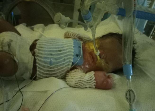 S-a năcut fără piele pe tot corpul iar medicii nu-i dădeau nici o șansă! Un bebeluș a luptat până în ultima clipă pentru a fi alături de mama lui: „Dacă nu ar fi avut scopul său de a fi aici, ar fi fost plecat de la naștere”