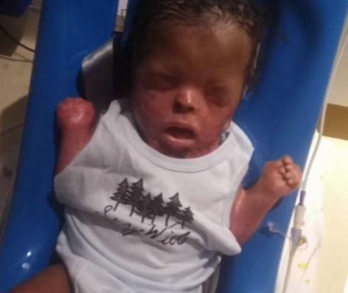 S-a năcut fără piele pe tot corpul iar medicii nu-i dădeau nici o șansă! Un bebeluș a luptat până în ultima clipă pentru a fi alături de mama lui: „Dacă nu ar fi avut scopul său de a fi aici, ar fi fost plecat de la naștere”