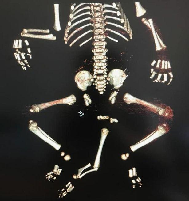 O femeie a născut, pe cale naturală, un bebeluș cu trei picioare: „Am știut că este bolnav, dar am refuzat să renunț la el”