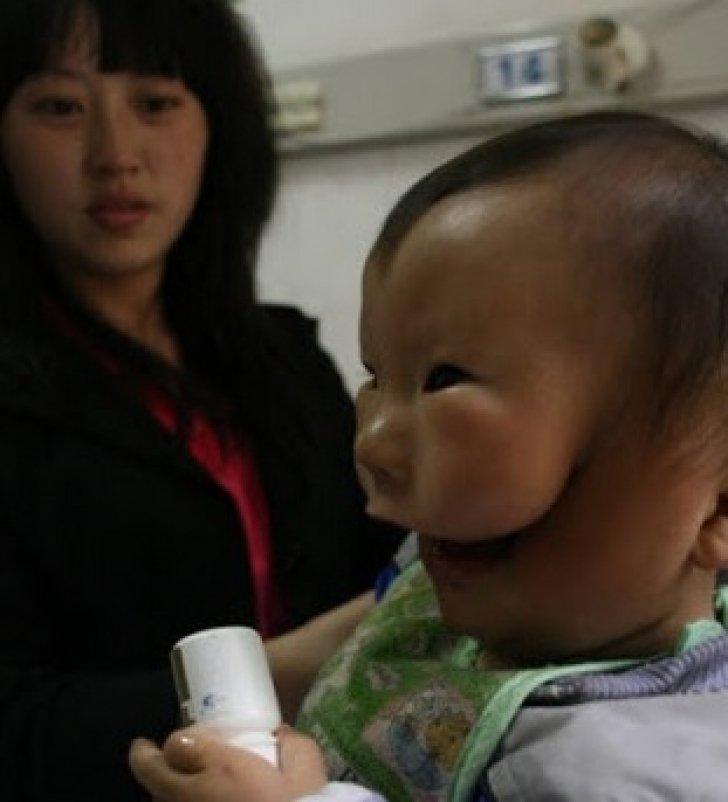 Când a văzut ce a adus pe lume, mama a împietrit de durere! Din cauza unei afecțiuni groaznice, copilul pare că are nu una, ci două fețe!