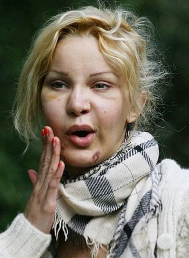 Terifiant! Femeia care şi-a făcut 350 de intervenţii estetice: “Nu îmi vine să cred în ce m-am transformat!“