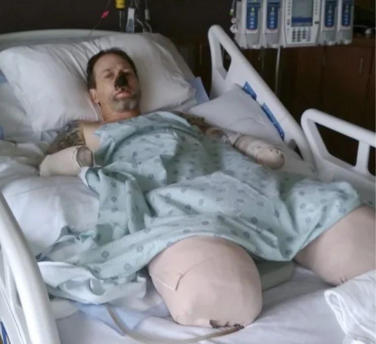 Aproape a murit după ce a fost lins de un câine, iar acum refuză să își dea animalul de companie. Bărbatul a rămas fără mâini și picioare însă și-a păstrat atitudinea pozitivă