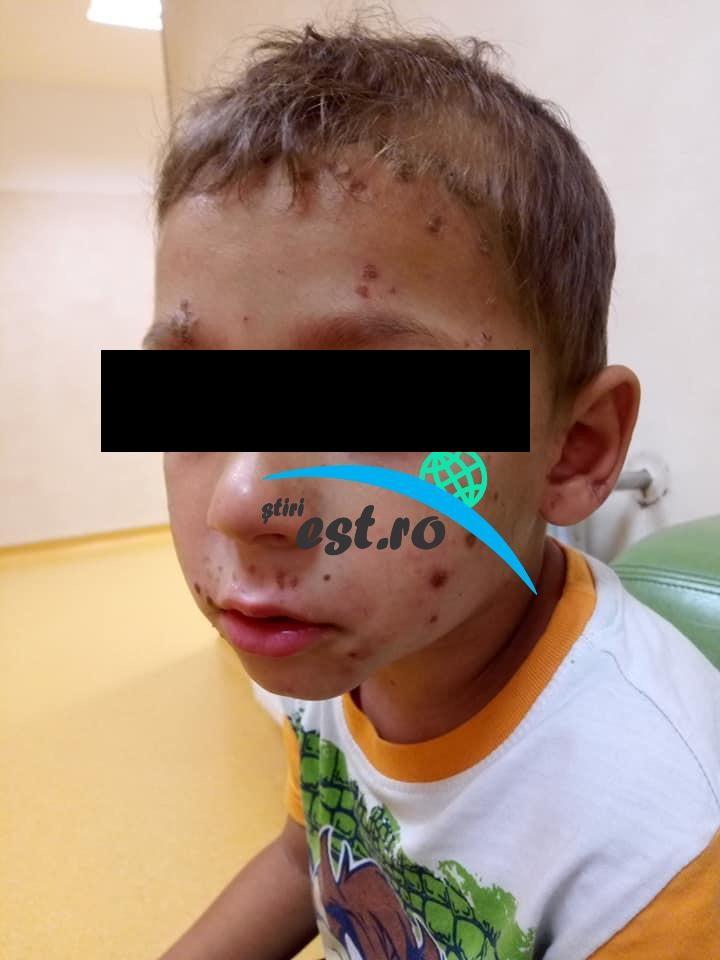 Copii cu pielea infectată, flămânzi și ținuți în mizerie, la Suceava. Mama nu-i spală, au păduchi și sunt plini de bube, acuză vecinii