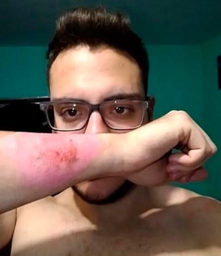 Un tânăr a folosit o răzătoare pentru a-și scoate tatuajul de pe mână! Rezultatul a fost de nedescris!