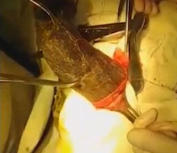 A ajuns la spital cu dureri severe și a fost operată de urgență! Medicilor nu le-a venit să creadă ce avea tânăra în stomac! Atenție, imagini tulburătoare! Foto