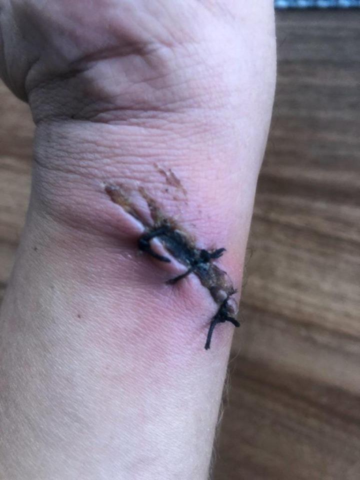 Dezvăluiri șoc! Cusătură de „animal”, primită de un pacient din Bistrița! „Bătaie de joc...”