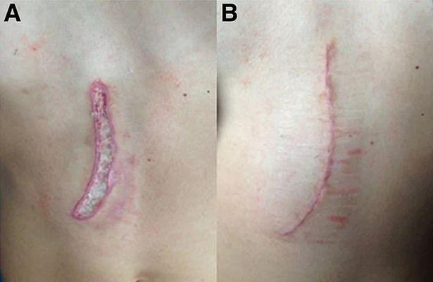 O adolescentă de 13 ani s-a ales cu arsuri grave pe corp după ce și-a folosit telefonul în timp ce făcea baie! Medicii trag un semnal de alarmă - FOTO