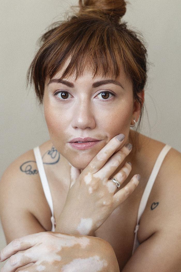 Imagini fabuloase - Suferă de aceeași boală ca Michael Jackson, dar a ridicat "defectul" la rang de artă!