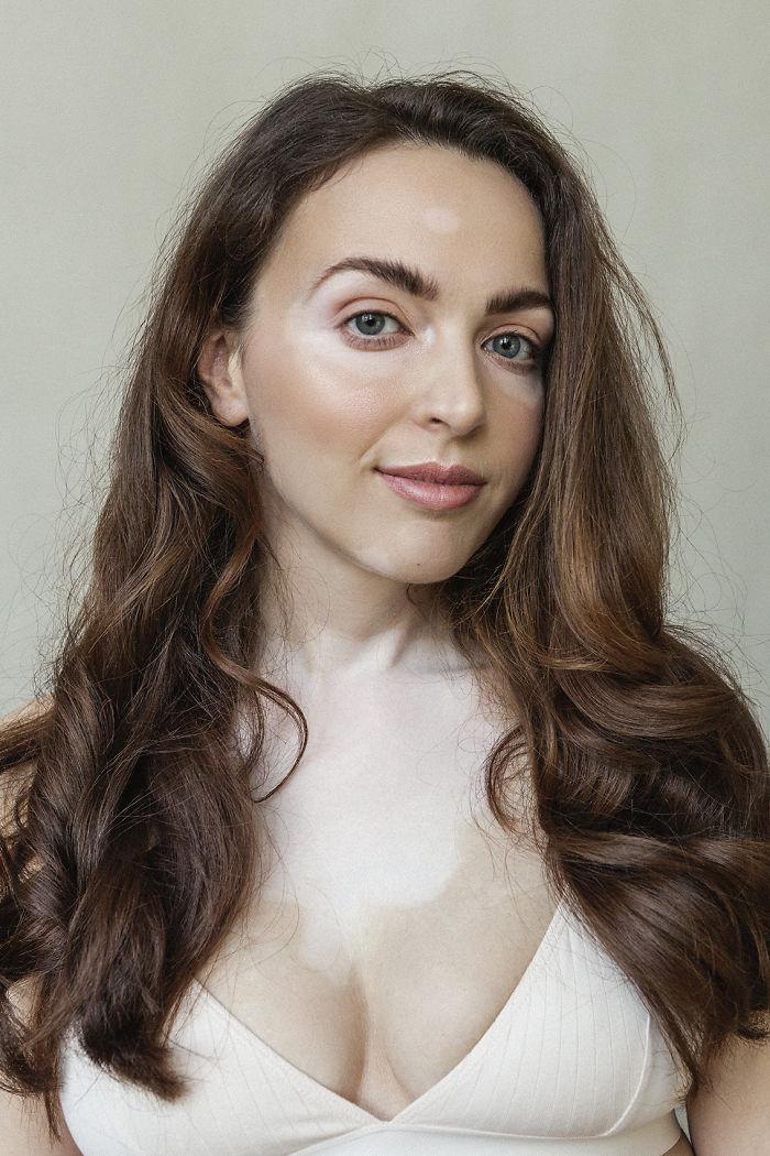 Imagini fabuloase - Suferă de aceeași boală ca Michael Jackson, dar a ridicat "defectul" la rang de artă!