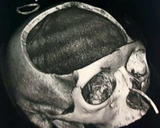 Ziua Mondială a Victimelor Traficului Rutier: O tânără a vorbit despre cum și-a pierdut jumătate din craniu din cauza unui accident rutier - FOTO